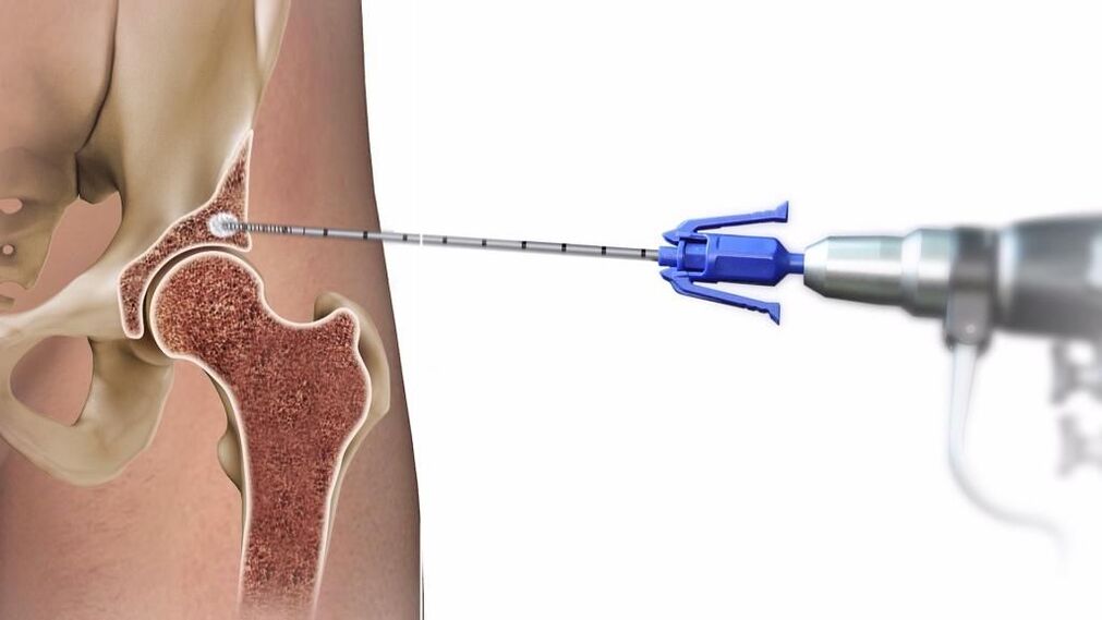 hip joint injections