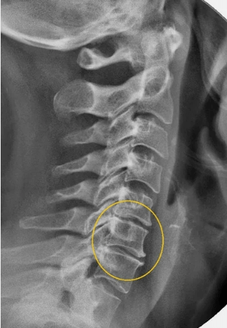Cervical spine osteochondrosis in an x ​​-ray
