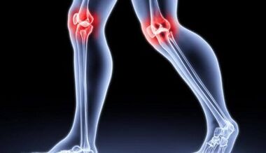 Prevention of the development of arthritis and arthrosis