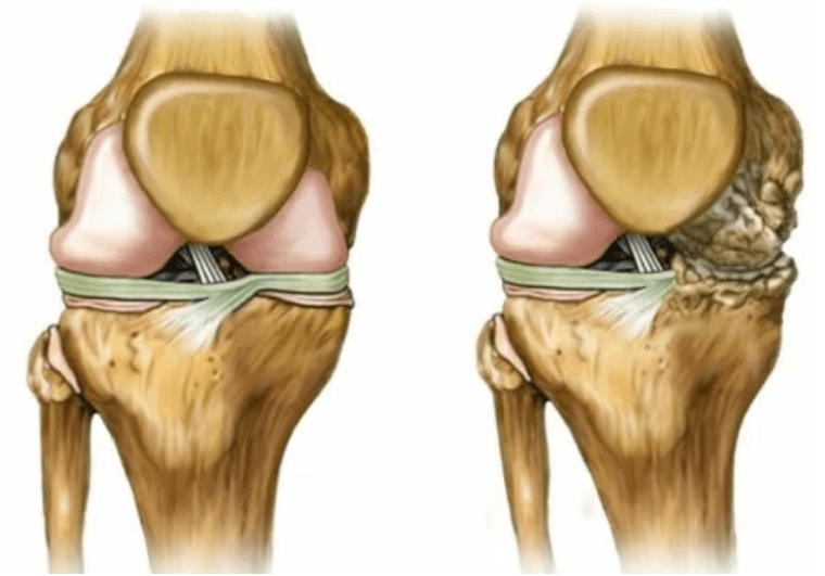 Arthrosis stages