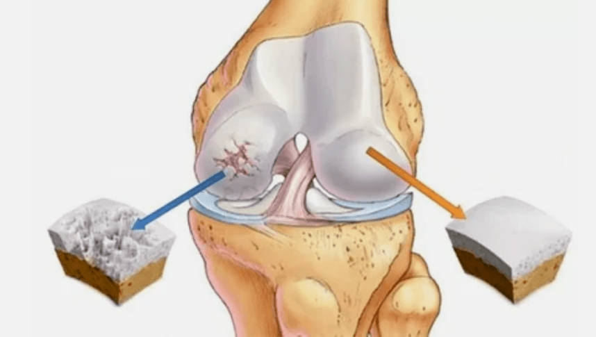 How arthrosis develops