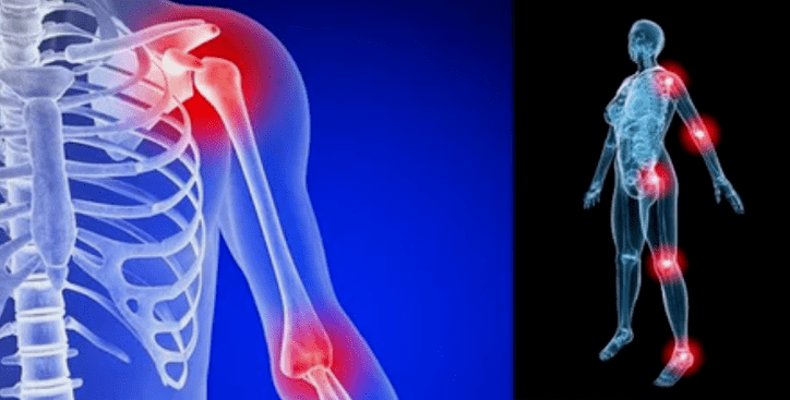 Member deformation for arthrosis