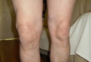 manifestations of arthrosis of the knee joint (1)