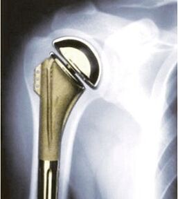 Shoulder replacement for osteoarthritis
