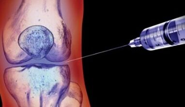 joint arthrosis treatment methods