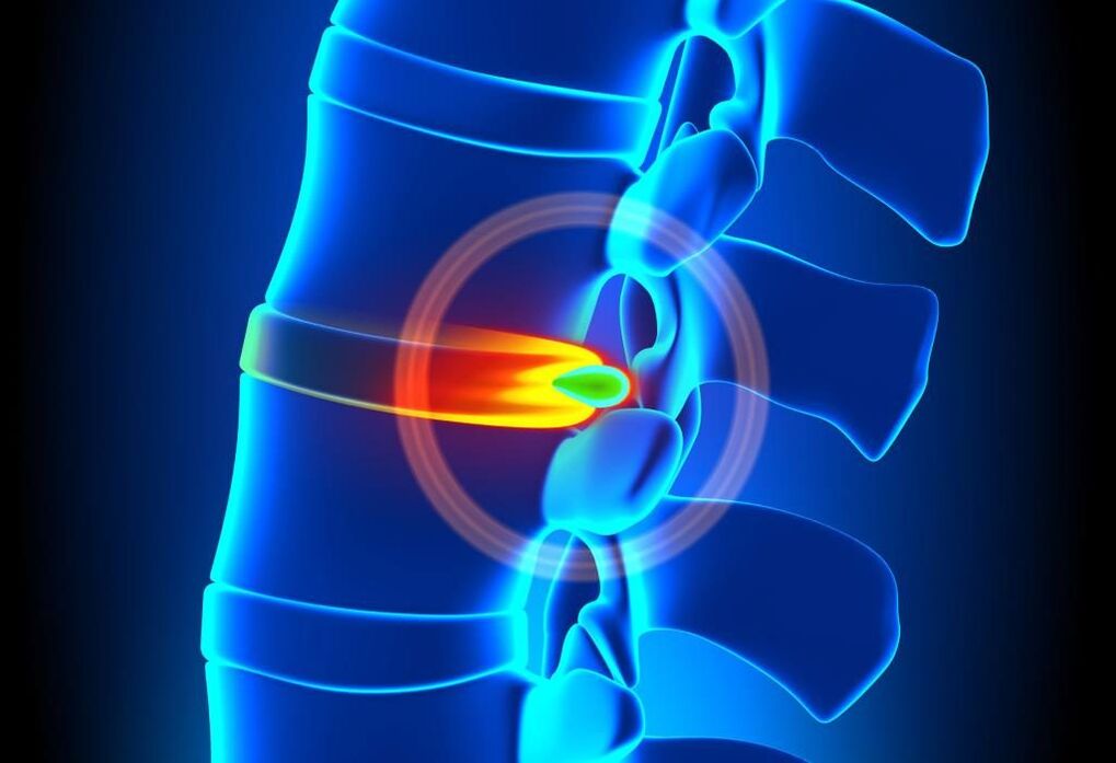 spinal injury with cervical osteochondrosis