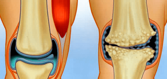 Normal Articulation and Arthrosis